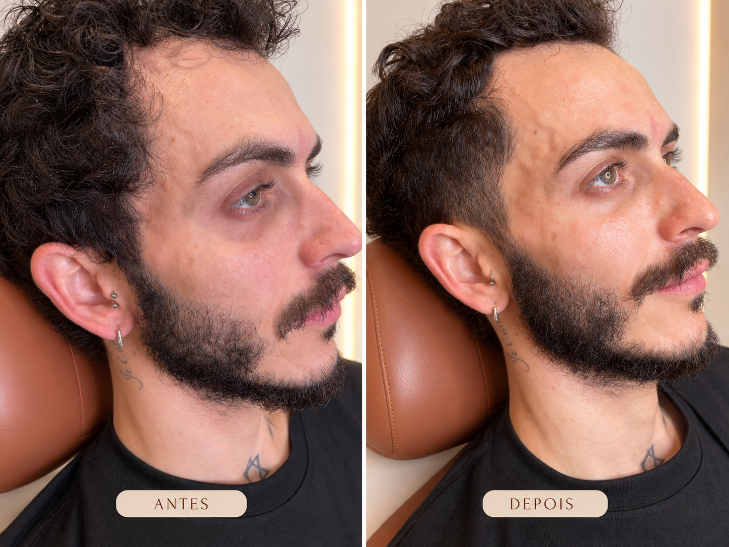 Antes e depois de 35 minutos de massagem facial